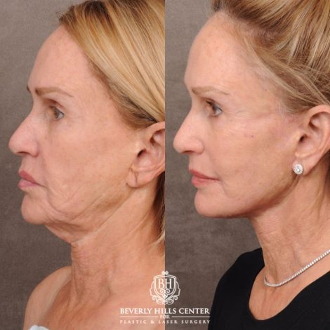 Beverly Hills Center Female Patient Before and After AuraLyft with CUPID LIFT® Corner Lift