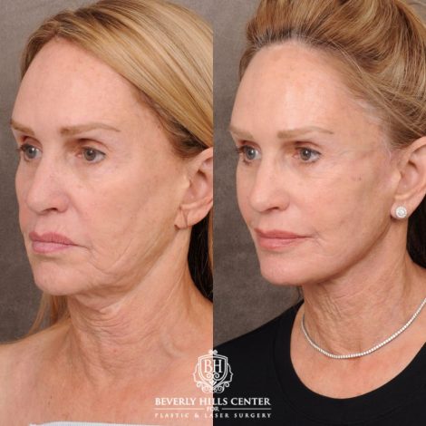 Beverly Hills Center Female Patient Before and After AuraLyft with CUPID LIFT® Corner Lift