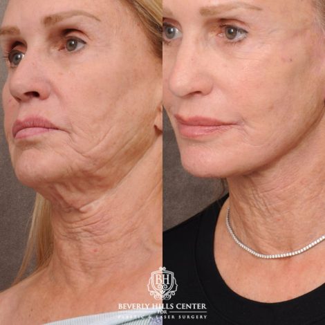 Beverly Hills Center Female Patient Before and After AuraLyft with CUPID LIFT® Corner Lift