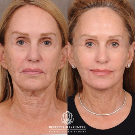 Beverly Hills Center Female Patient Before and After AuraLyft with CUPID LIFT® Corner Lift