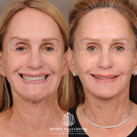 Beverly Hills Center Female Patient Before and After AuraLyft with CUPID LIFT® Corner Lift