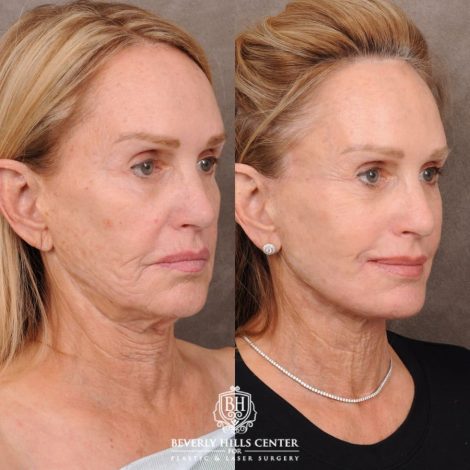 Beverly Hills Center Female Patient Before and After AuraLyft with CUPID LIFT® Corner Lift