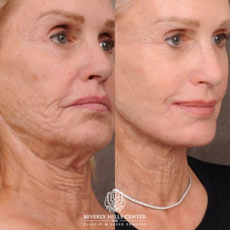 Beverly Hills Center Female Patient Before and After AuraLyft with CUPID LIFT® Corner Lift