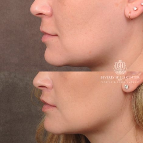 Beverly Hills Center Female Patient Before and After CUPID LIFT® Lip Lift