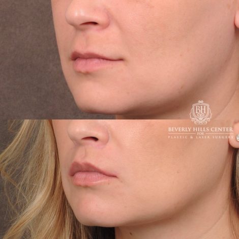 Beverly Hills Center Female Patient Before and After CUPID LIFT® Lip Lift