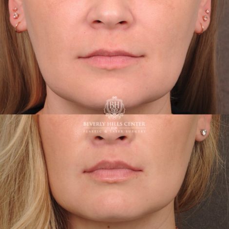 Beverly Hills Center Female Patient Before and After CUPID LIFT® Lip Lift