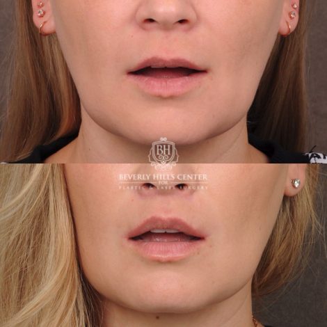 Beverly Hills Center Female Patient Before and After CUPID LIFT® Lip Lift