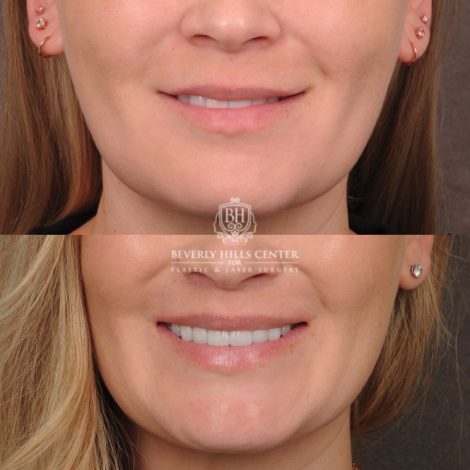 Beverly Hills Center Female Patient Before and After CUPID LIFT® Lip Lift