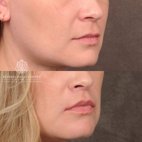 Beverly Hills Center Female Patient Before and After CUPID LIFT® Lip Lift