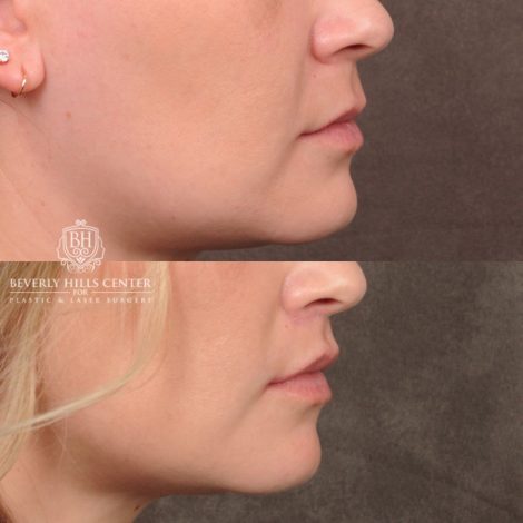 Beverly Hills Center Female Patient Before and After CUPID LIFT® Lip Lift