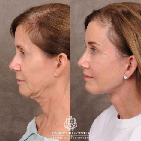 Beverly Hills Center Female Patient Before and After Comprehensive AuraLyft with CUPID LIFT® Corner Lift