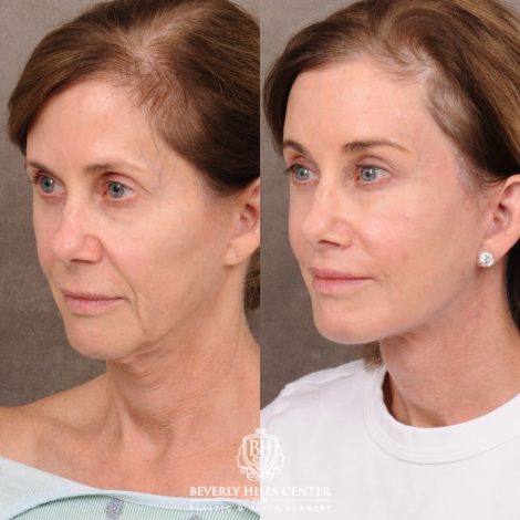 Beverly Hills Center Female Patient Before and After Comprehensive AuraLyft with CUPID LIFT® Corner Lift