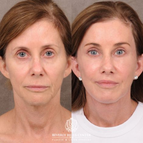 Beverly Hills Center Female Patient Before and After Comprehensive AuraLyft with CUPID LIFT® Corner Lift