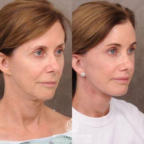 Beverly Hills Center Female Patient Before and After Comprehensive AuraLyft with CUPID LIFT® Corner Lift