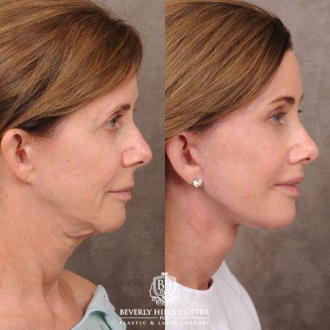 Beverly Hills Center Female Patient Before and After Comprehensive AuraLyft with CUPID LIFT® Corner Lift