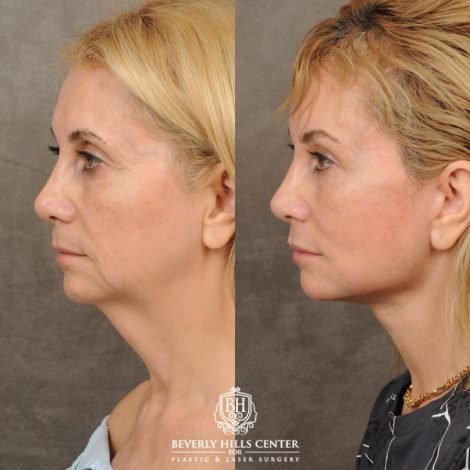 Beverly Hills Center Female Patient Before and After AuraLyft, Brow Lift, Upper Blepharoplasty, Earlobe Reduction