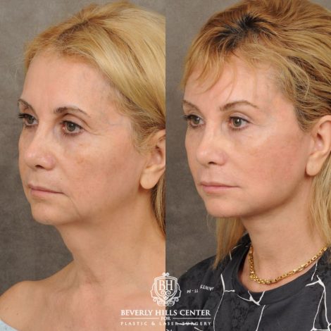 Beverly Hills Center Female Patient Before and After AuraLyft, Brow Lift, Upper Blepharoplasty, Earlobe Reduction