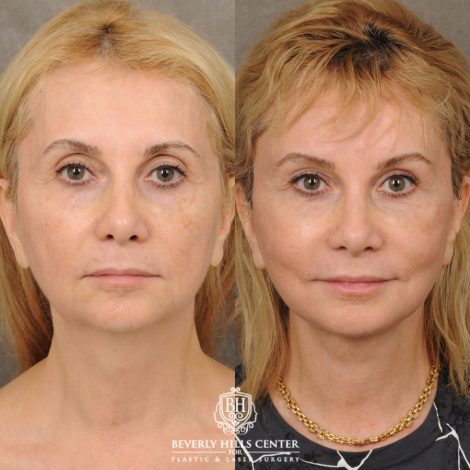 Beverly Hills Center Female Patient Before and After AuraLyft, Brow Lift, Upper Blepharoplasty, Earlobe Reduction