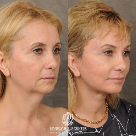 Beverly Hills Center Female Patient Before and After AuraLyft, Brow Lift, Upper Blepharoplasty, Earlobe Reduction