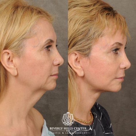 Beverly Hills Center Female Patient Before and After AuraLyft, Brow Lift, Upper Blepharoplasty, Earlobe Reduction