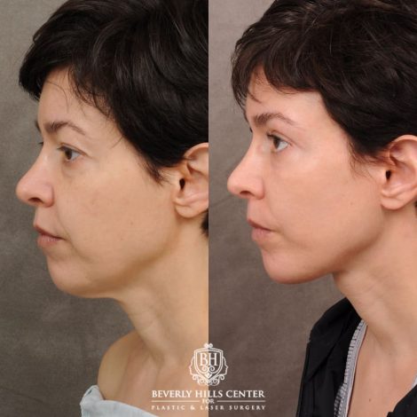 Beverly Hills Center Female Patient Before and After AuraLyft, Upper Blepharoplasty, Fat Grafting