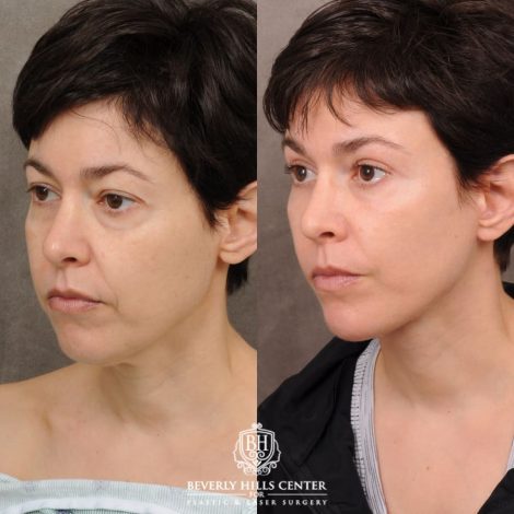 Beverly Hills Center Female Patient Before and After AuraLyft, Upper Blepharoplasty, Fat Grafting