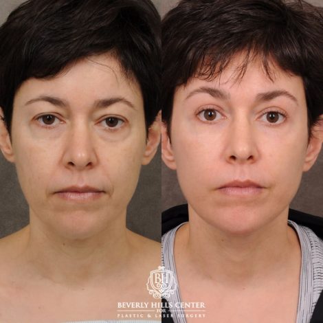 Beverly Hills Center Female Patient Before and After AuraLyft, Upper Blepharoplasty, Fat Grafting