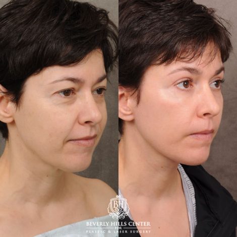 Beverly Hills Center Female Patient Before and After AuraLyft, Upper Blepharoplasty, Fat Grafting