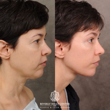 Beverly Hills Center Female Patient Before and After AuraLyft, Upper Blepharoplasty, Fat Grafting