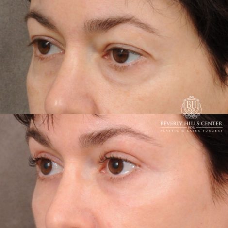 Beverly Hills Center Female Patient Before and After AuraLyft, Upper Blepharoplasty, Fat Grafting