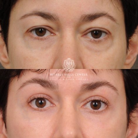 Beverly Hills Center Female Patient Before and After AuraLyft, Upper Blepharoplasty, Fat Grafting