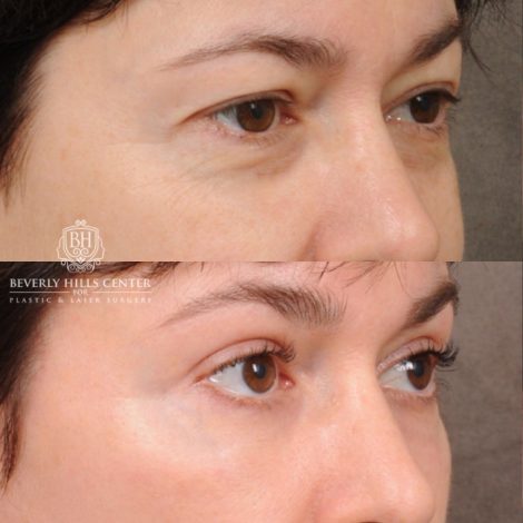 Beverly Hills Center Female Patient Before and After AuraLyft, Upper Blepharoplasty, Fat Grafting