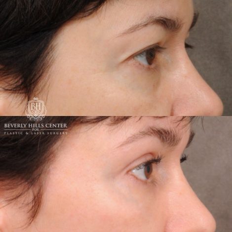 Beverly Hills Center Female Patient Before and After AuraLyft, Upper Blepharoplasty, Fat Grafting