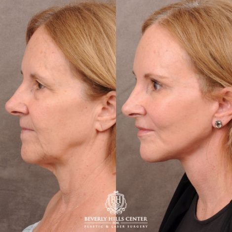 Beverly Hills Center Female Patient Before and After AuraLyft, Brow Lift, Nanofat with PRP