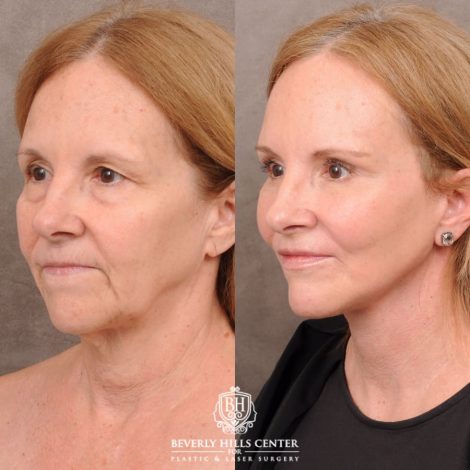 Beverly Hills Center Female Patient Before and After AuraLyft, Brow Lift, Nanofat with PRP