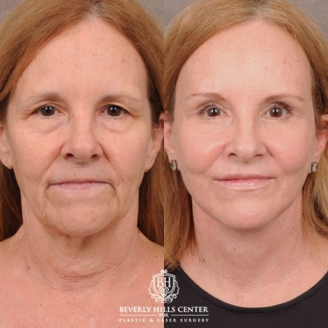 Beverly Hills Center Female Patient Before and After AuraLyft, Brow Lift, Nanofat with PRP