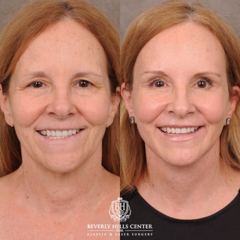 Beverly Hills Center Female Patient Before and After AuraLyft, Brow Lift, Nanofat with PRP