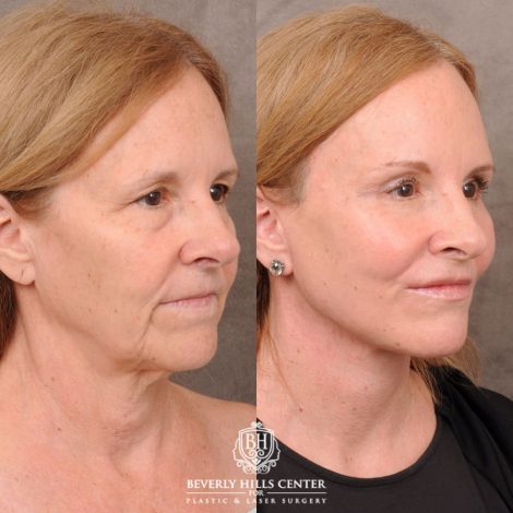 Beverly Hills Center Female Patient Before and After AuraLyft, Brow Lift, Nanofat with PRP