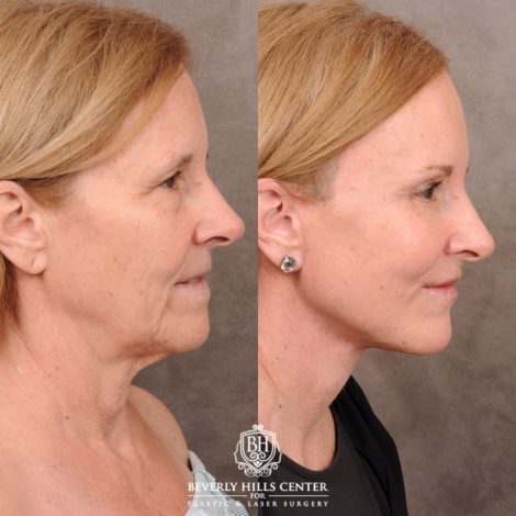 Beverly Hills Center Female Patient Before and After AuraLyft, Brow Lift, Nanofat with PRP
