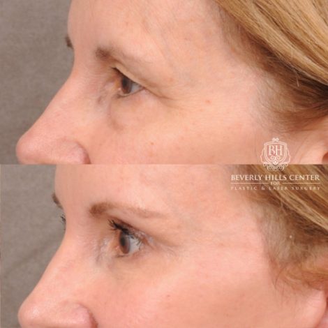 Beverly Hills Center Female Patient Before and After AuraLyft, Brow Lift, Upper & Lower Blepharoplasty, CUPID LIFT® Lip Lift