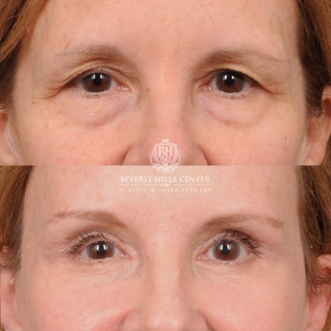 Beverly Hills Center Female Patient Before and After AuraLyft, Brow Lift, Upper & Lower Blepharoplasty, CUPID LIFT® Lip Lift