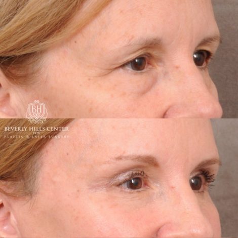 Beverly Hills Center Female Patient Before and After AuraLyft, Brow Lift, Upper & Lower Blepharoplasty, CUPID LIFT® Lip Lift