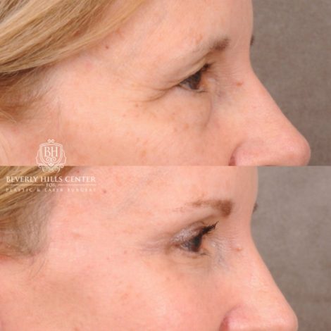 Beverly Hills Center Female Patient Before and After AuraLyft, Brow Lift, Upper & Lower Blepharoplasty, CUPID LIFT® Lip Lift