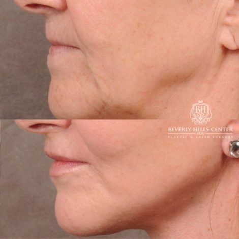 Beverly Hills Center Female Patient Before and After AuraLyft, Brow Lift, Nanofat with PRP