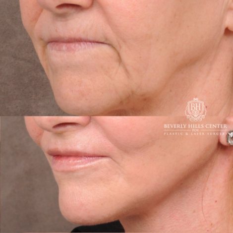 Beverly Hills Center Female Patient Before and After AuraLyft, Brow Lift, Nanofat with PRP