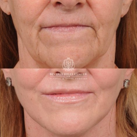 Beverly Hills Center Female Patient Before and After AuraLyft, Brow Lift, Nanofat with PRP