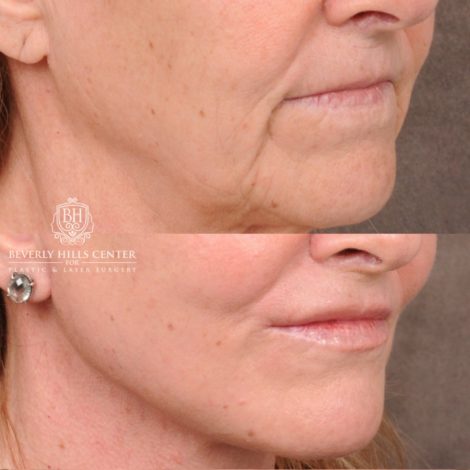 Beverly Hills Center Female Patient Before and After AuraLyft, Brow Lift, Nanofat with PRP