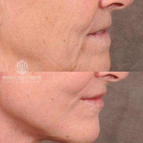 Beverly Hills Center Female Patient Before and After AuraLyft, Brow Lift, Nanofat with PRP