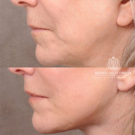 Beverly Hills Center Female Patient Before and After AuraLyft, CUPID LIFT®, Brow Lift, Upper Blepharoplasty, Fat Grafting, and Earlobe Repair
