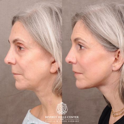 Beverly Hills Center Female Patient Before and After AuraLyft, CUPID LIFT®, Brow Lift, Upper Blepharoplasty, Fat Grafting, and Earlobe Repair